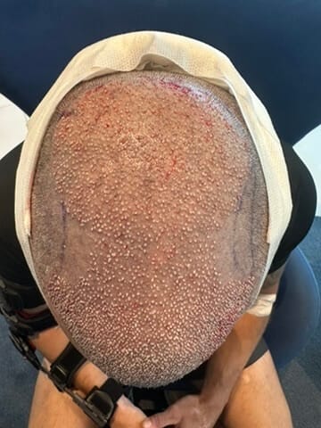 Hair Transplant In Turkey